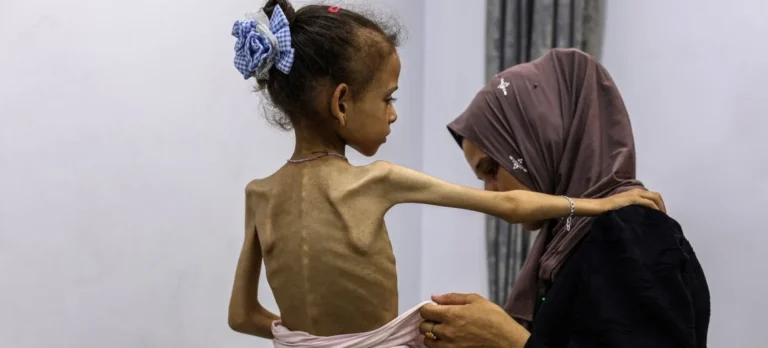 صحة غزة في يوم الأغذية العالمي: 466 حالة وفاة بينهم 157 طفلاً منذ 2024 بفعل التجويع